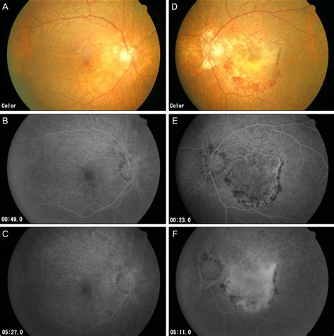 Incidence of new neovascular AMD in the fellow eye. | Download ...