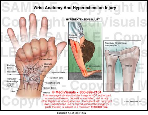 Hyperextension Anatomy