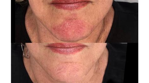 Vbeam Laser Rosacea Side Effects The Best Picture Of Beam