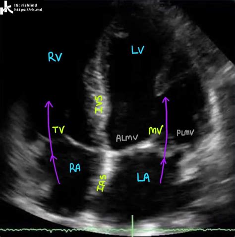 Cardiac Transthoracic Echocardiography TTE Summary And Labeled