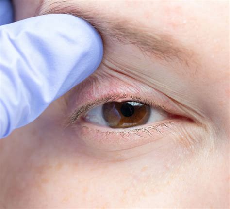 How To Remove Bump On Eyelid Eyelid Bump Types Pictures Causes And Treatment