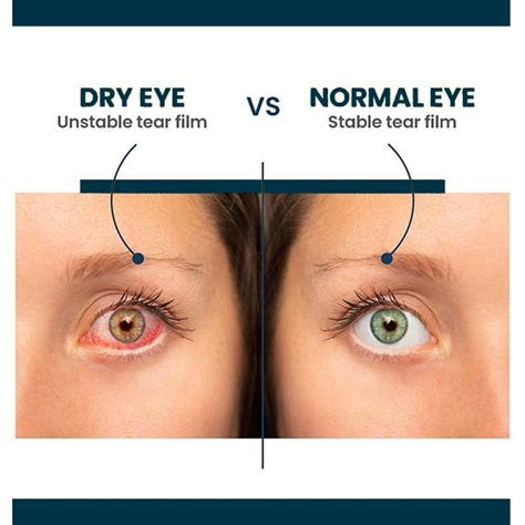 Dry Eye Treatment Norwalk Vision Dry Eye Center