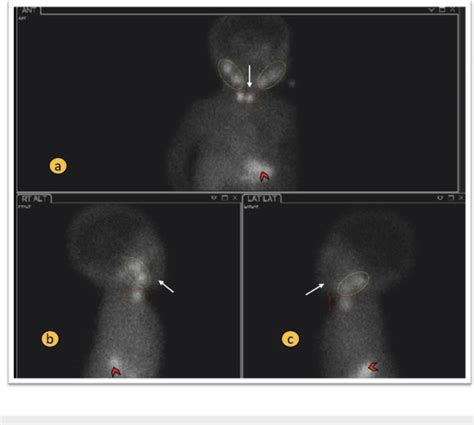 Normal Radionuclide Thyroid Scan Anterior And Lateral Views Panels