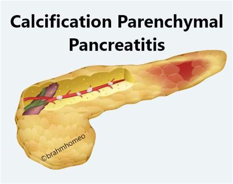 Acute Pancreatitis Treatment Acute Pancreatitis Specialists