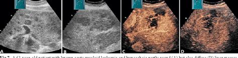 Figure 7 From Comments And Illustrations Of The WFUMB CEUS Liver