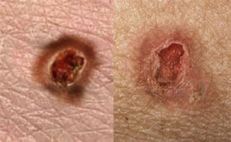 Main Type Of Skin Cancer — Their Differences Histology And Prevention — Andréas Astier