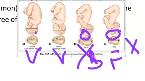 Vertex Position Fetal Position In