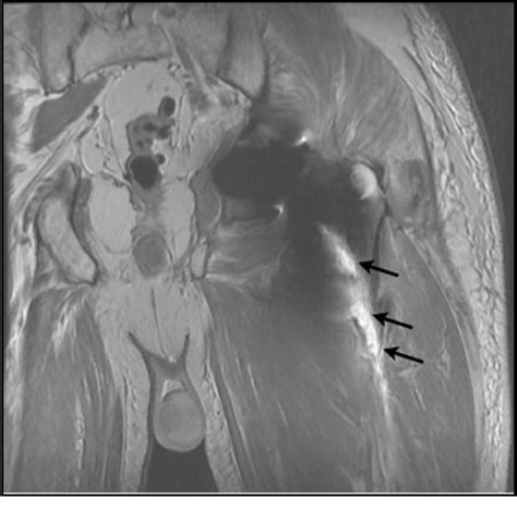 Figure From Sciatic Palsy After Total Hip Arthroplasty Associated