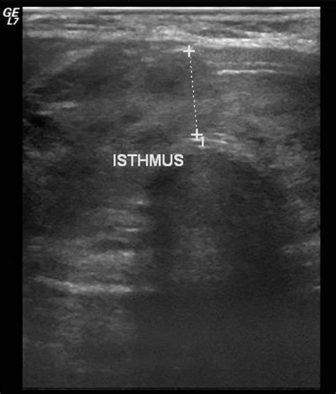 Isthmus Thyroid Ultrasound