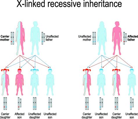 Duchenne Muscular Dystrophy Diagram