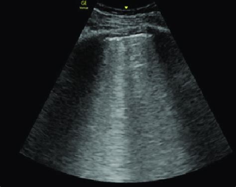 Point Of Care Lung Ultrasound Demonstrating Confluent Blines A Finding