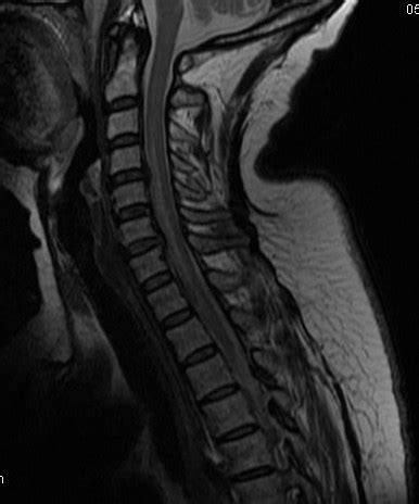 Anterior Spinal Cord Infarction MRI Sumer S Radiology Blog