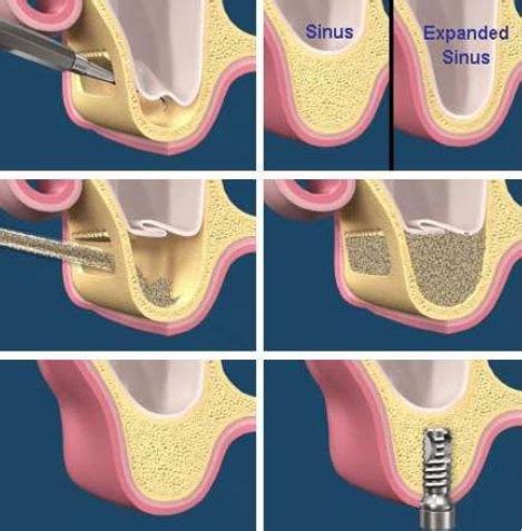 Torrance Bone Grafting For Dental Implants Palos Verdes Sinus Lifts