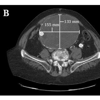 Follow Up Computed Tomography Ct Scans Showing Progressive Aneurysm