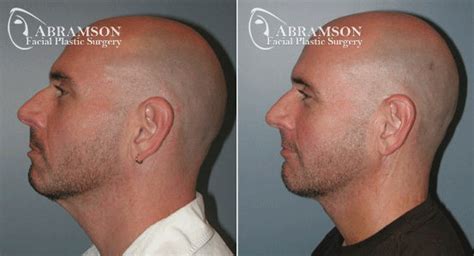 Mini and Full Facelift Before and After Photos | Abramson Facial Plastic Surgery