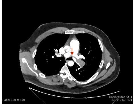 Saddle Pulmonary Embolus Cta Annotated Red Arrow 2 Jetem 2019 Jetem