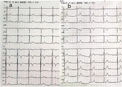 Figure 1 From Electrocardiographic Findings Of Wellens Syndrome Due To