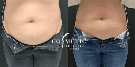 Emsculpt Neo Cost Info Before And After Sherman Oaks