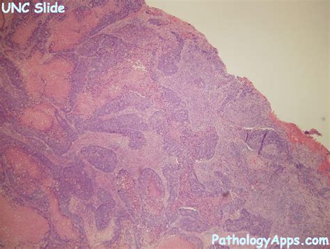 adenosquamous carcinoma pathology