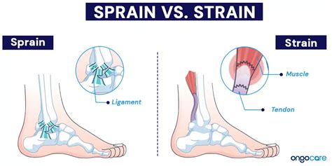 Sprains And Strains Understanding Causes Symptoms And Treatment