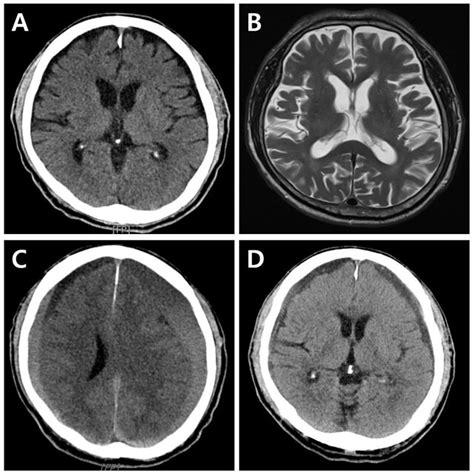 Brain images of the patient. (A) Brain computed tomography scan ...