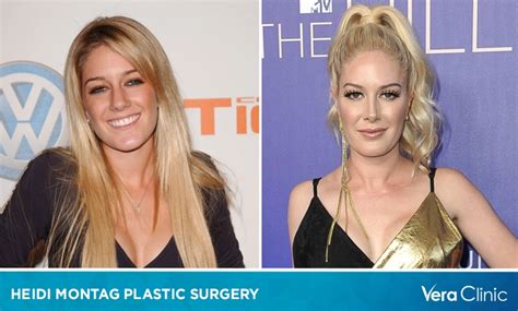 Heidi Montag Plastic Surgery: A Transformation Journey