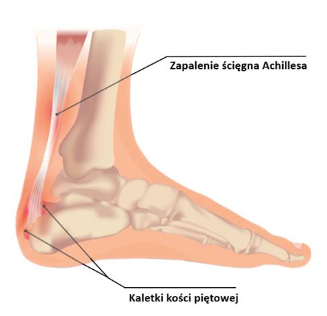 Zapalenie Ci Gna Achillesa Objawy Przyczyny Leczenie I