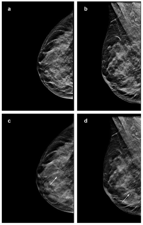 Breast Cancer Digital Mammogram