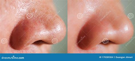 Before And After Acne On Nose Treatment Stock Photo Image Of Concept