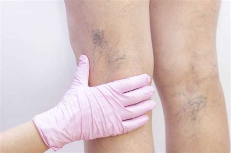 Varicose Vein Treatments Explained Palm Clinic