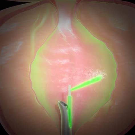 Green Light Laser Prostate Surgery Reviews Shelly Lighting