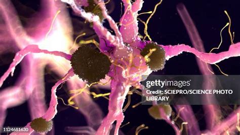 36 Amyloid Plaques Brain Stock Photos, High-Res Pictures, and Images ...