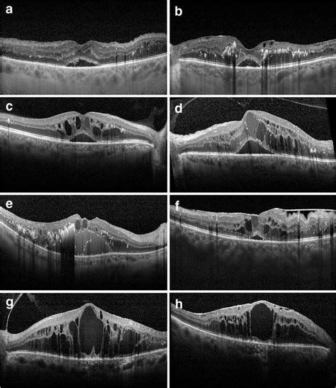 Clinically Significant Macular Edema Oct