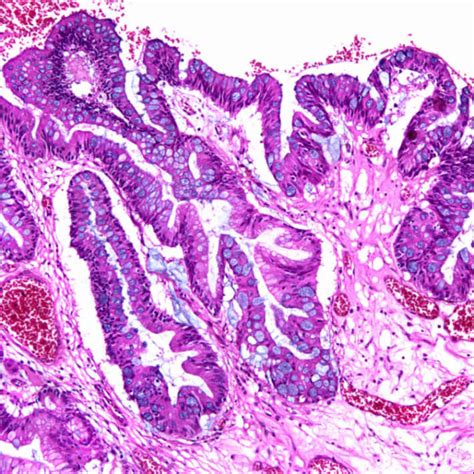 Hyperplastic Polyps Basicmedical Key