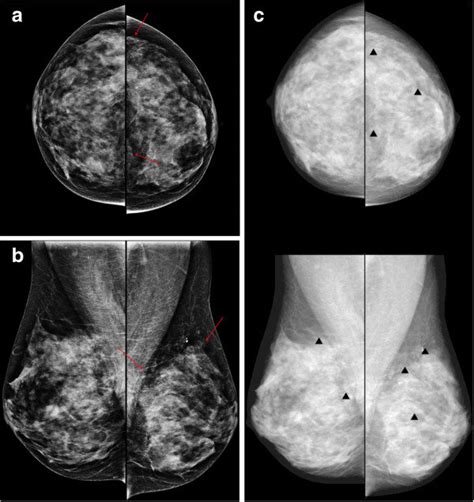 A Year Old Woman With Fibrocystic Changes In The Left Breast