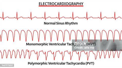 Set Of Ecg Common Abnormalities Normal Sinus Rhythm Monomorphic Vt