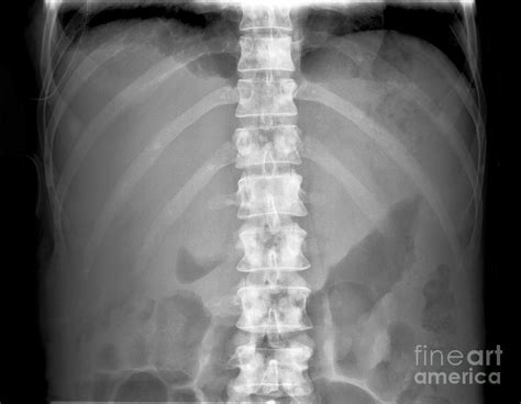 Secondary Bone Cancer X Ray Photograph By Science Photo Library Fine