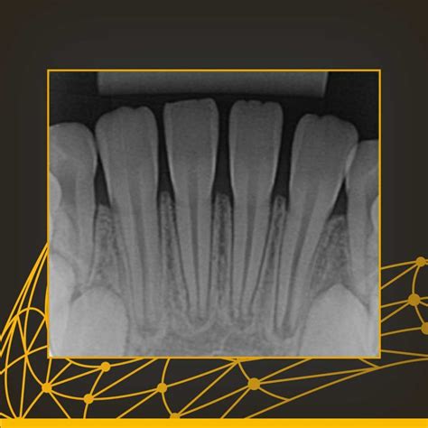 Radiografia Periapical Como Feita