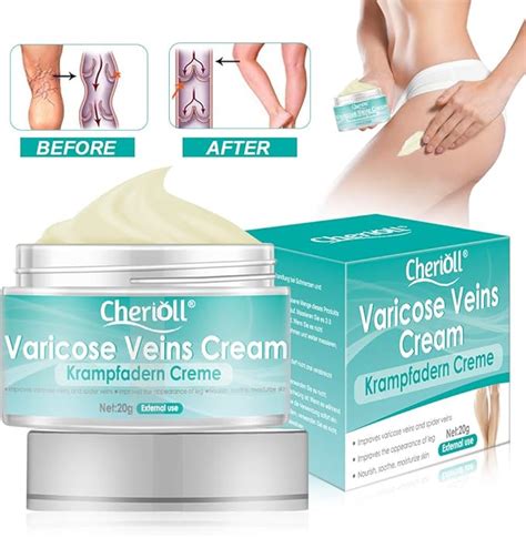 Crema Para Varices Mejora La Circulación Sanguínea En Las Piernas