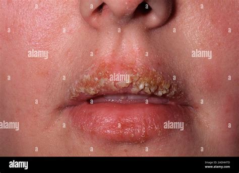 Impetigo Infection On The Upper Lip Of A 26 Year Old Woman Impetigo