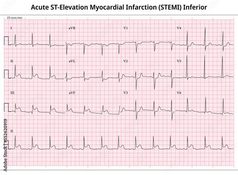 Acute ST-Elevation Myocardial Infarction (STEMI) Inferior - ECG Paper 12 Lead Stock Illustration ...