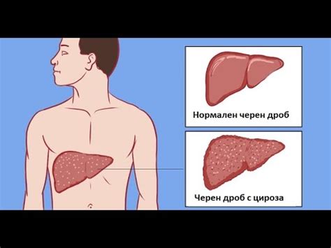 Пациентите с цироза не са обречени! - YouTube