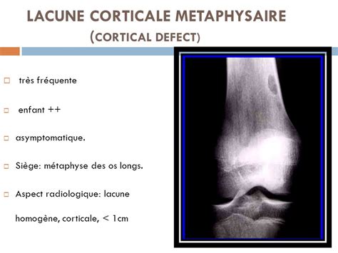 Imagerie Des Tumeurs Osseuses Benignes Ppt Video Online T L Charger