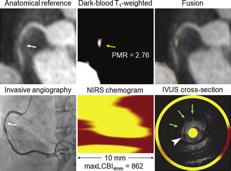 A Representative Case Of High Intensity Plaque And Lipid Rich Plaque In