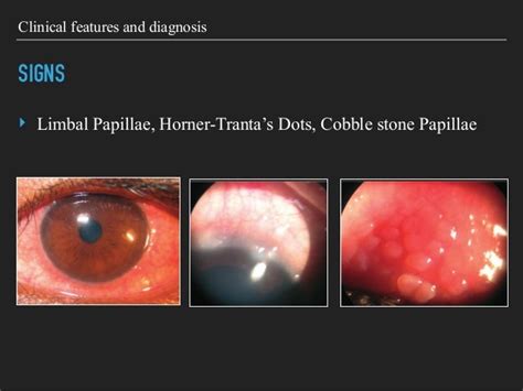 VERNAL KERATOCONJUNCTIVITIS