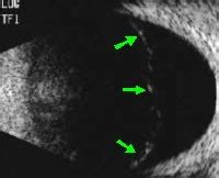 Distacco Della Retina Predisposizione Sintomi Terapia E Prevenzione