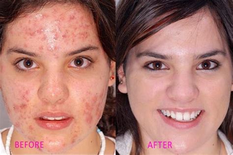 Rosacea Treatment Natural Remedies | Beauty Health & Fashion