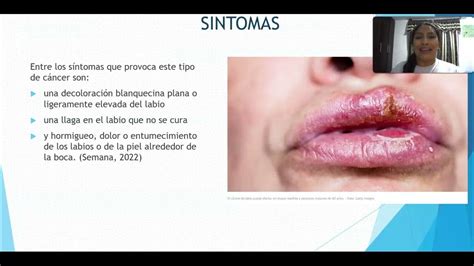 Tema Cáncer De Labios Youtube
