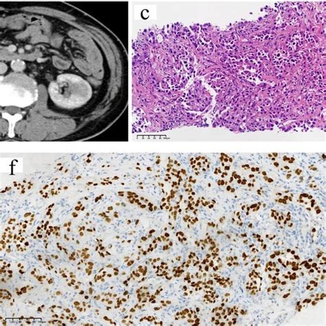 Renal Metastasis From Primary Lung Adenocarcinoma From Case A Ct