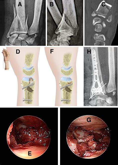 Arthroscopic Reduction In And Fixation Of Distal Radius Fracture With